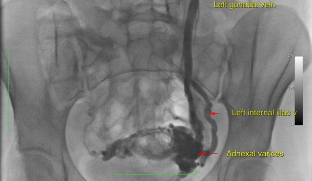 Ovarian Vein Embolisation Specialist Endovascular Services